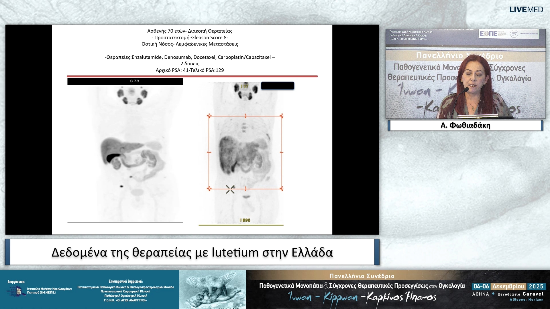 77 Α. Φωθιαδάκη - Δεδομένα της θεραπείας με lutetium στην Ελλάδα