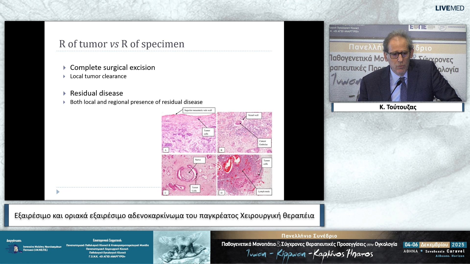 18 Κ. Τούτουζας - Εξαιρέσιμο και οριακά εξαιρέσιμο αδενοκαρκίνωμα του παγκρέατος • Χειρουργική θεραπεία
