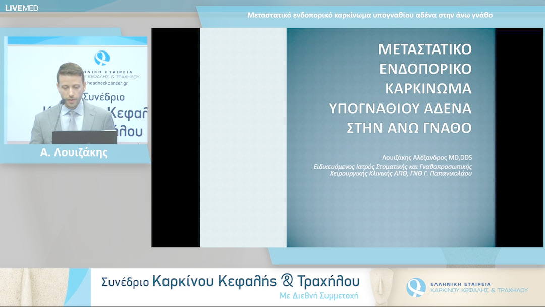 14 Α. Λουιζάκης - Μεταστατικό ενδοπορικό καρκίνωμα υπογναθίου αδένα στην άνω γνάθο 