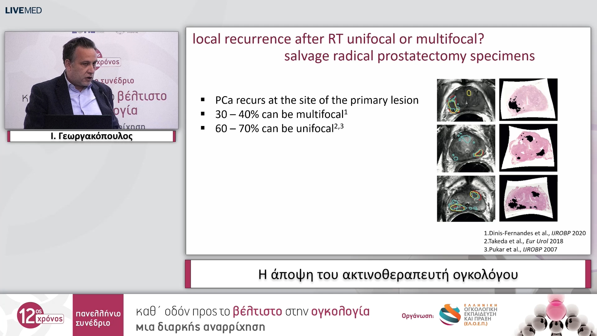 18 Ι. Γεωργακόπουλος - Η άποψη του ακτινοθεραπευτή ογκολόγου