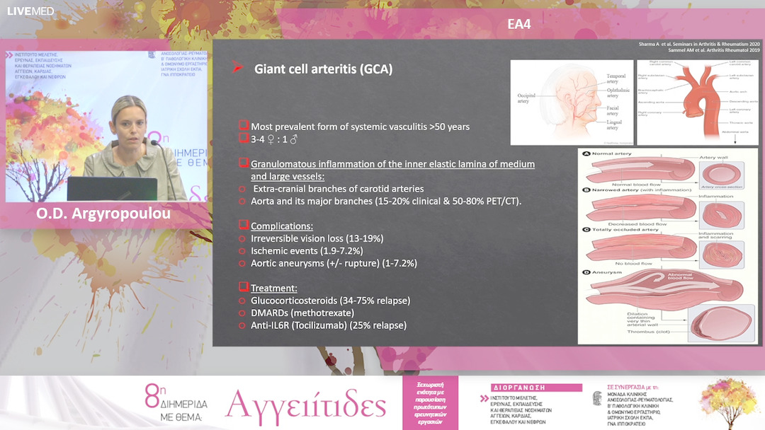 04 O.D Argyropoulou - ΕΑ4: 1H-NMR BASED METABOLOMIC PROFILE OF PATIENTS WITH GIANT CELL ARTERITIS AND POLYMYALGIA RHEUMATICA IN ACTIVE AND INACTIVE DISEASE STATE