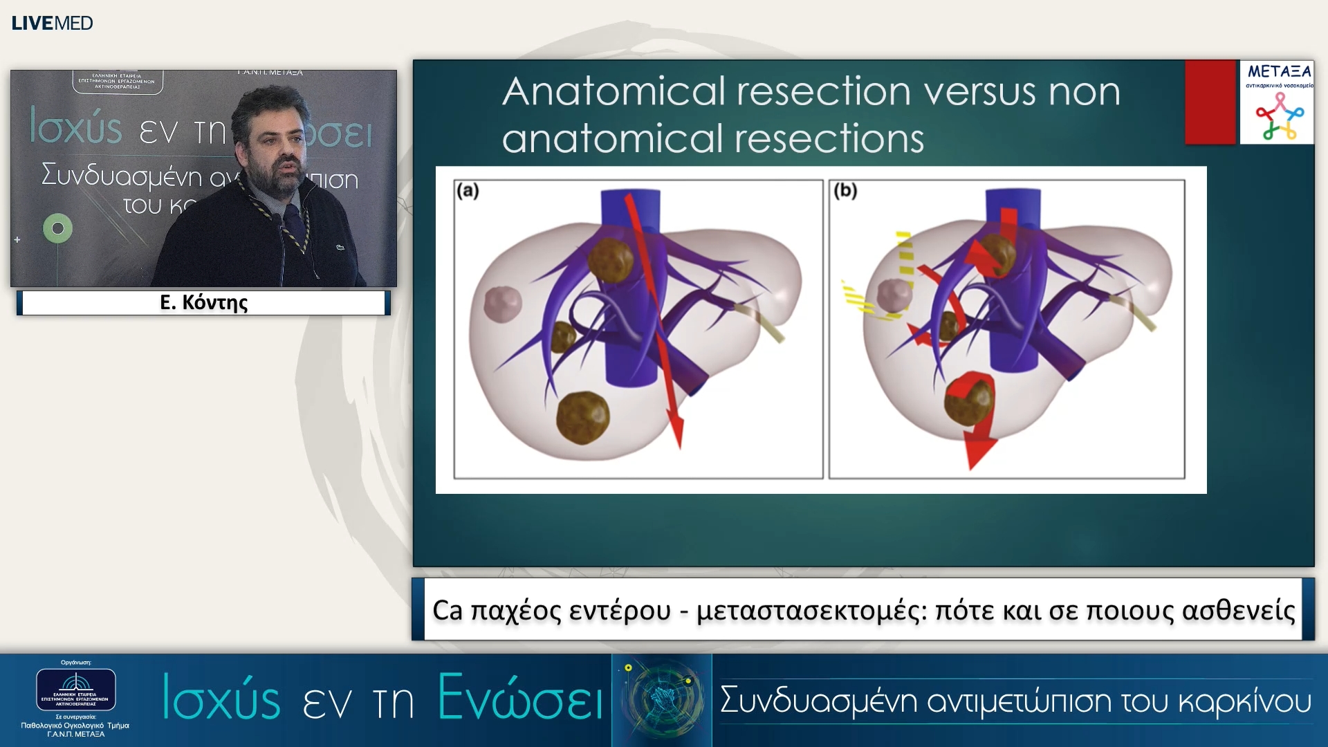 12 Ε. Κόντης - Ca παχέος εντέρου - μεταστασεκτομές: πότε και σε ποιους ασθενείς