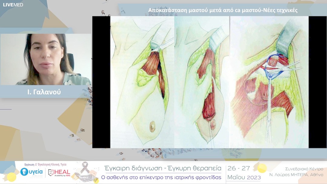 17 Ι. Γαλανού - Αποκατάσταση μαστού μετά από ca μαστούΝέες τεχνικές