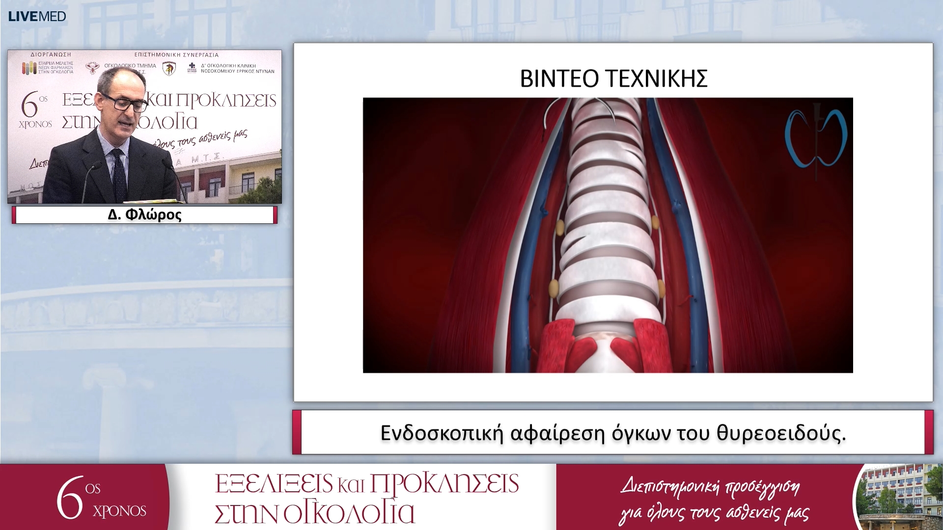 16 Δ. Φλώρος - Ενδοσκοπική αφαίρεση όγκων του θυρεοειδούς. 