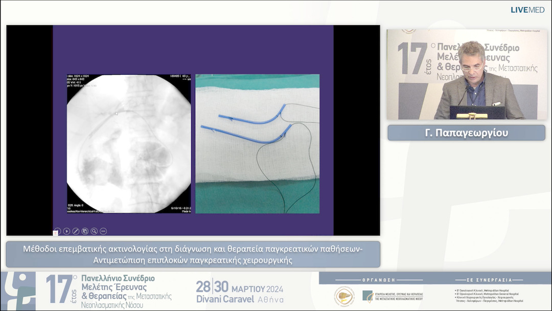 18 Γ. Παπαγεωργίου - Μέθοδοι επεμβατικής ακτινολογίας στη διάγνωση και θεραπεία παγκρεατικών παθήσεων-Αντιμετώπιση επιπλοκών παγκρεατικής χειρουργικής 