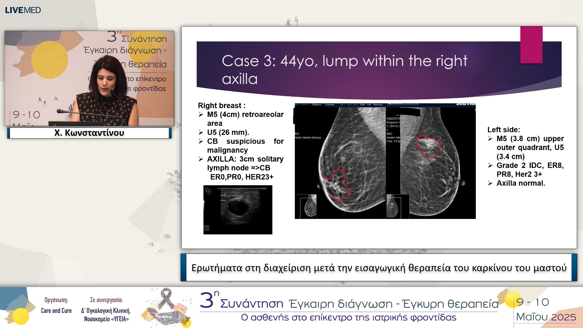 11 Χ. Κωνσταντίνου - Ενδιαφέροντα περιστατικά στην χειρουργική διαχείριση του καρκίνου του μαστού μετά την εισαγωγική θεραπεία.