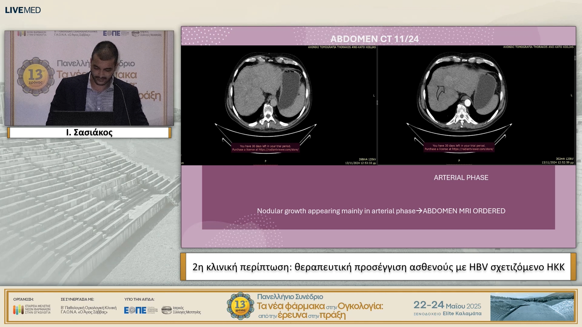 18 Ι. Σασιάκος - 2η κλινική περίπτωση: θεραπευτική προσέγγιση ασθενούς με ΗΒV σχετιζόμενο ΗΚΚ.