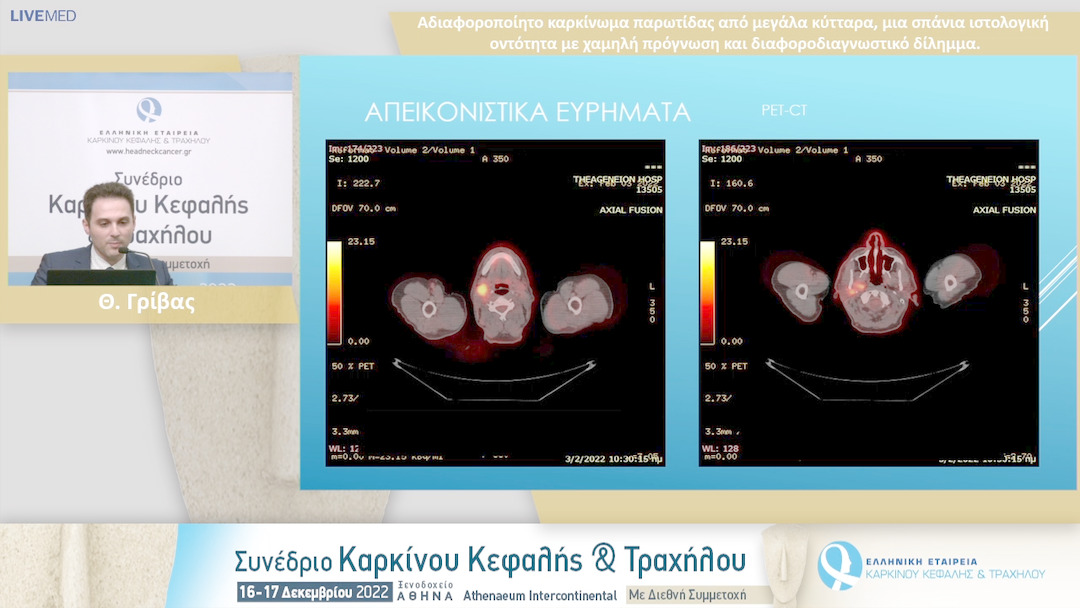 10  Θ. Γρίβας - Αδιαφοροποίητο καρκίνωμα παρωτίδας από μεγάλα κύτταρα,μια σπάνια ιστολογική οντότητα με χαμηλή πρόγνωση και διαφοροδιαγνωστικό δίλημμα.