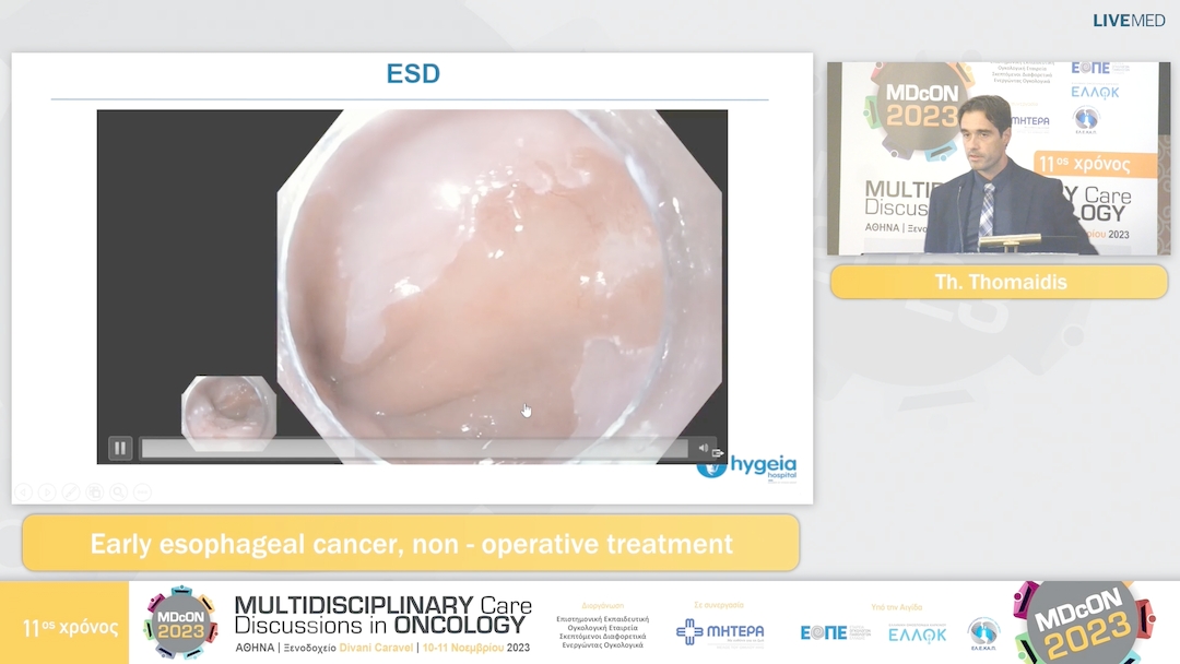 21 Th. Thomaidis - Early esophageal cancer, non - operative treatment 