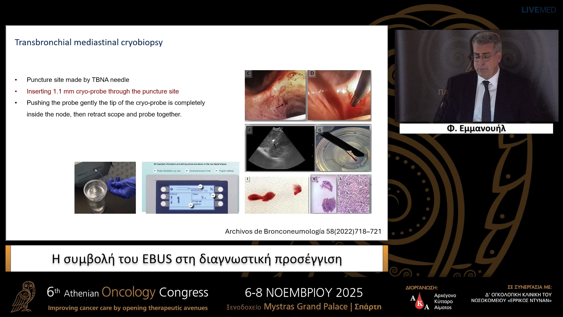 08 Φ. Εμμανουήλ - Η συμβολή του EBUS στη διαγνωστική προσέγγιση.