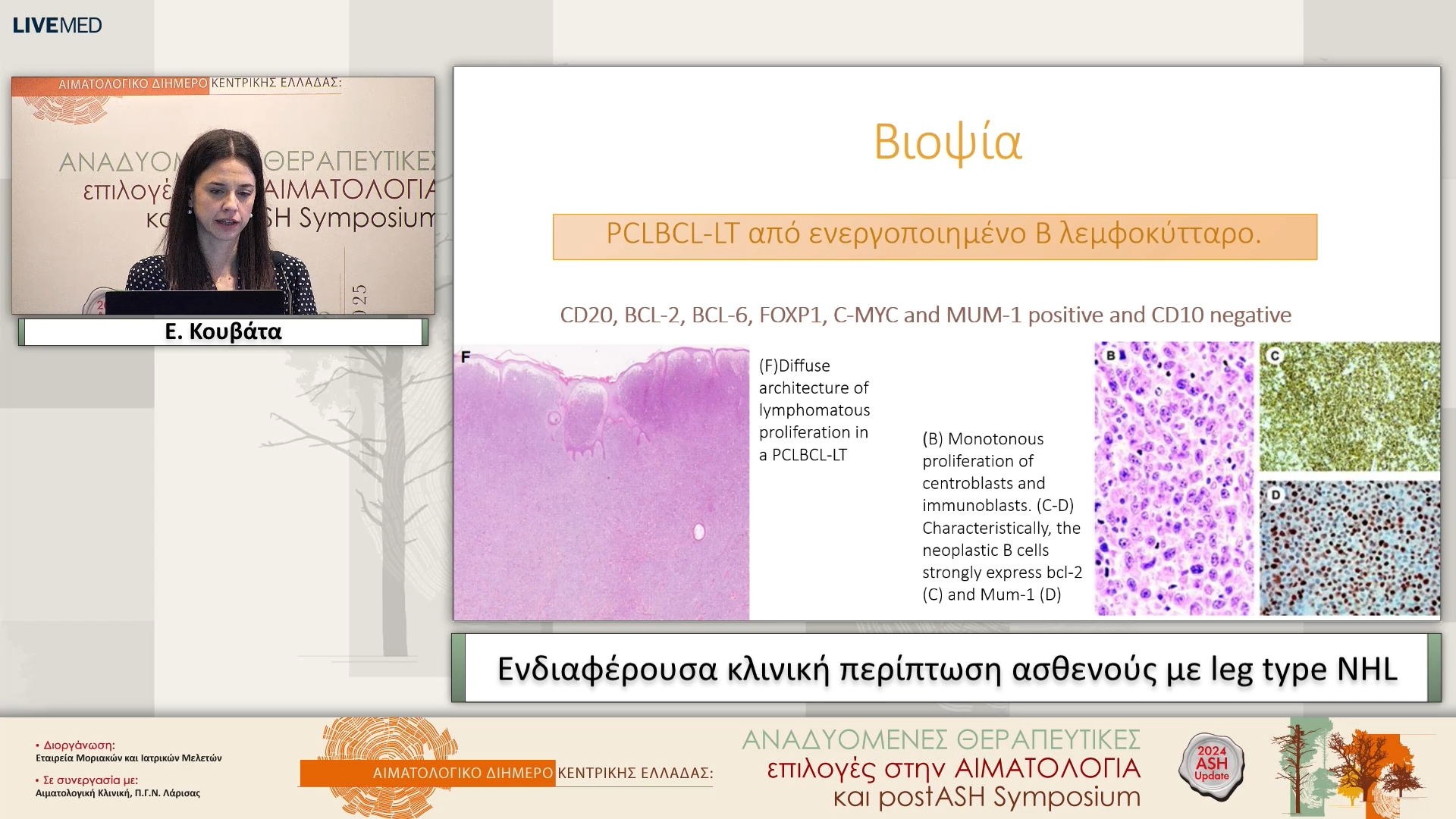 16 Ε. Κουβάτα - Ενδιαφέρουσα κλινική περίπτωση ασθενούς με leg type NHL 