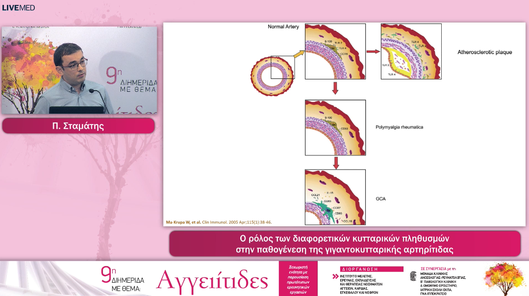 12 Π. Σταμάτης - Ο ρόλος των διαφορετικών κυτταρικών πληθυσμών στην παθογένεση της γιγαντοκυτταρικής αρτηρίτιδας