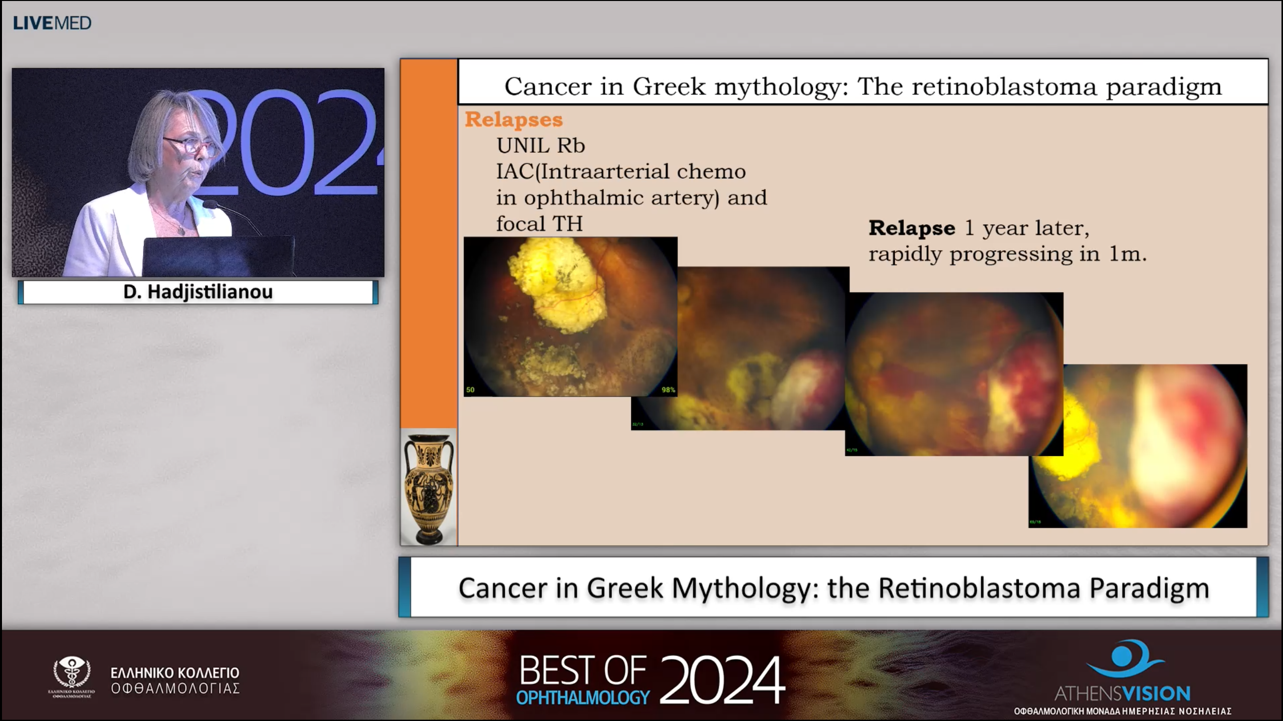 26 D. Hadjistilianou - Cancer in Greek Mythology: the Retinoblastoma Paradigm 