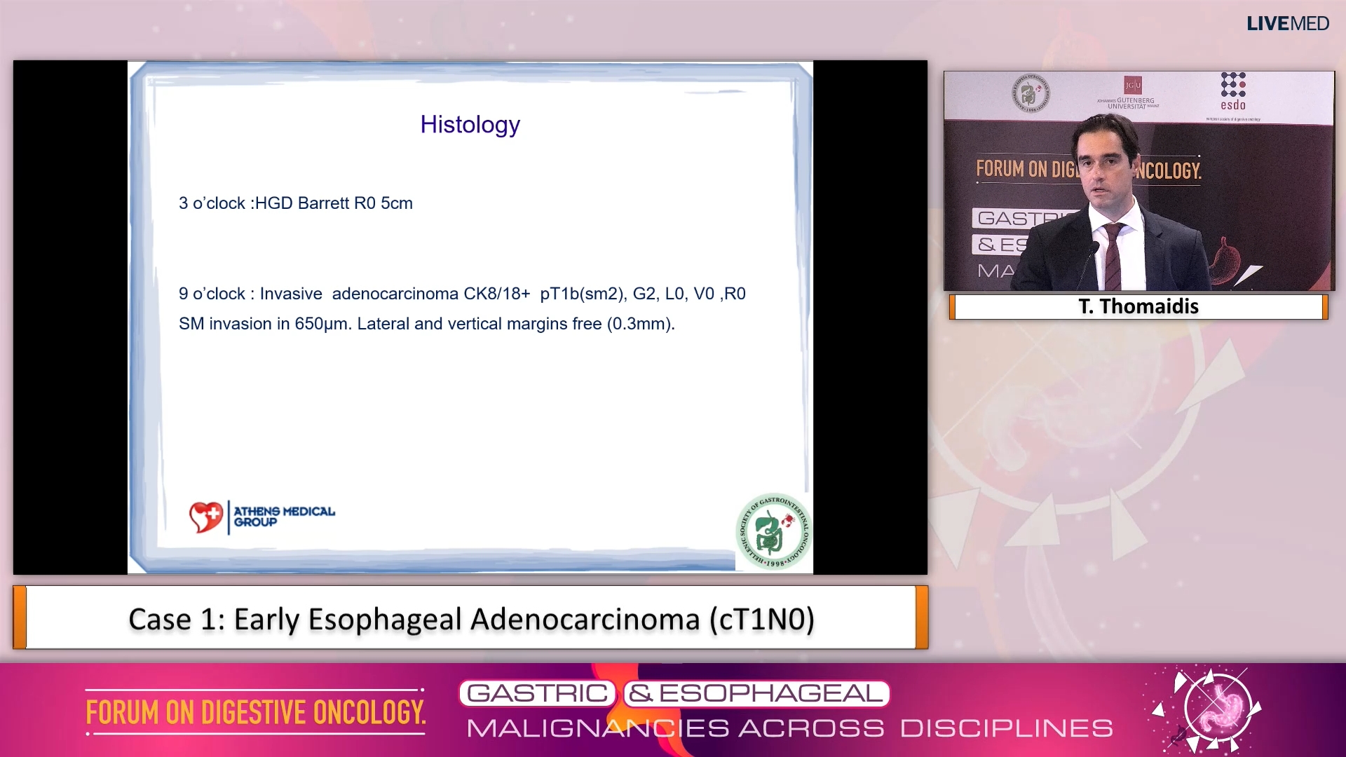 01 Case 1: Early Esophageal Adenocarcinoma (cT1N0)