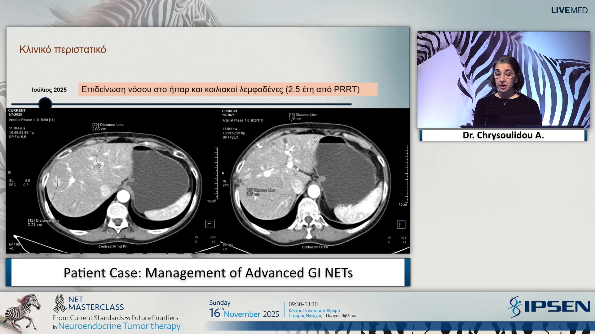 05 Dr. Chrysoulidou A. - Patient Case: Management of Advanced GI NETs