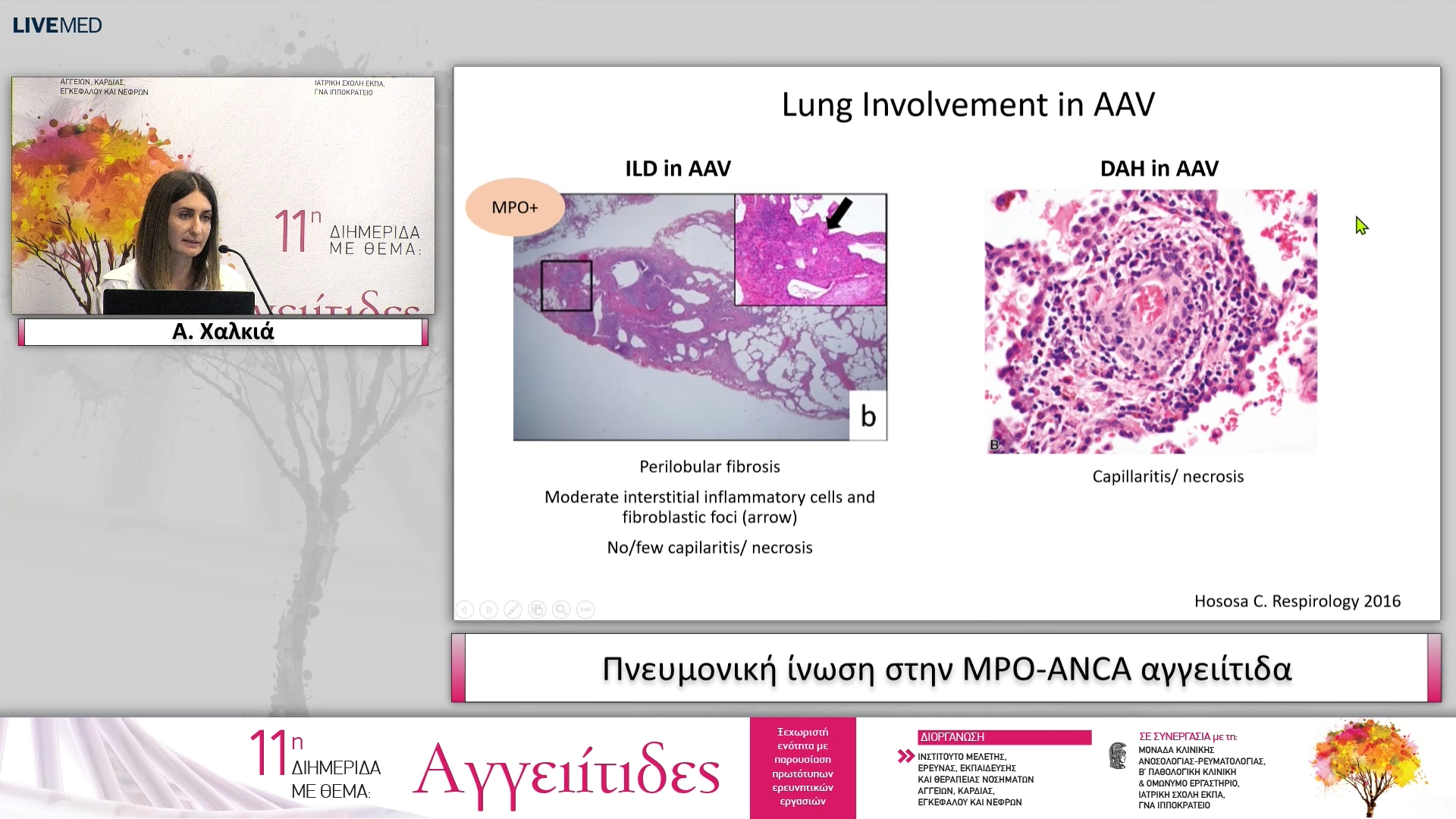 18 Α. Χαλκιά - Πνευμονική ίνωση στην MPO-ANCA αγγειίτιδα