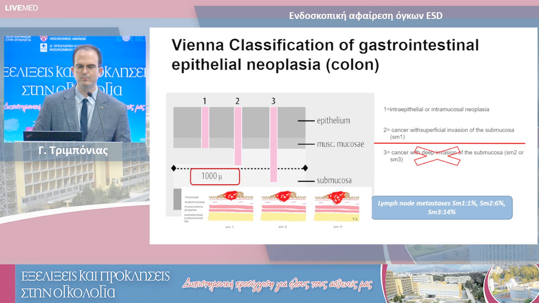 13  Γ. Τριμπόνιας - Ενδοσκοπική αφαίρεση όγκων ESD
