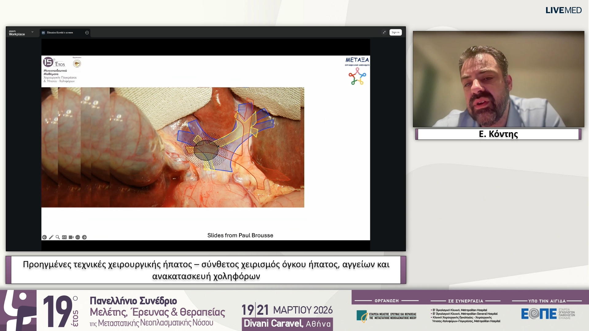 20 Ε. Κόντης - Προηγμένες τεχνικές χειρουργικής ήπατος – σύνθετος χειρισμός όγκου ήπατος, αγγείων και ανακατασκευή χοληφόρων 