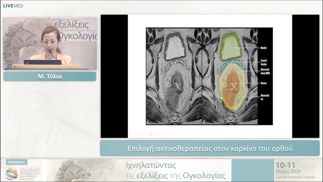 16 Μ. Τόλια - Επιλογή ακτινοθεραπείας στον καρκίνο του ορθού 