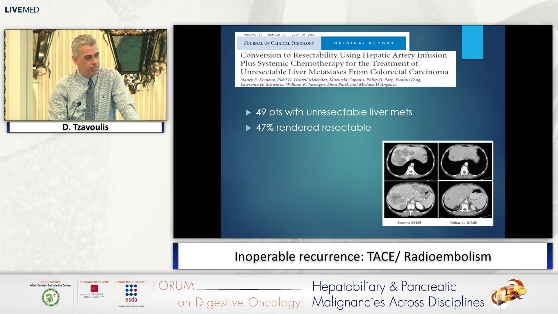 08 D. Tzavoulis - Inoperable recurrence: TACE/ Radioembolism 